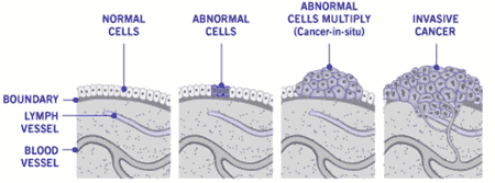 A diagram of cancer cells