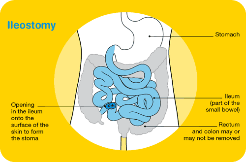 Coping with diet & bowel changes - Cancer Council Victoria