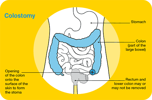 Coping with diet & bowel changes - Cancer Council Victoria