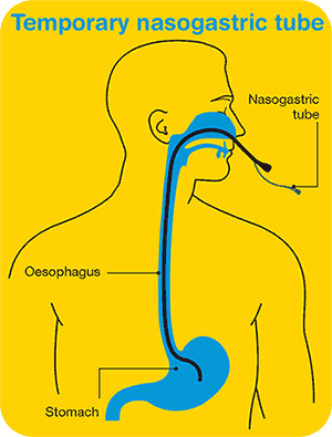 Side effects of head and neck cancers | Cancer Council Victoria