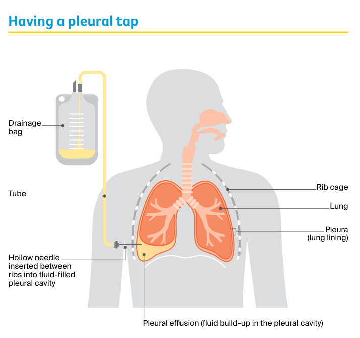 Expert Advice: Managing Lung Cancer Symptoms | Cancer Council Victoria ...