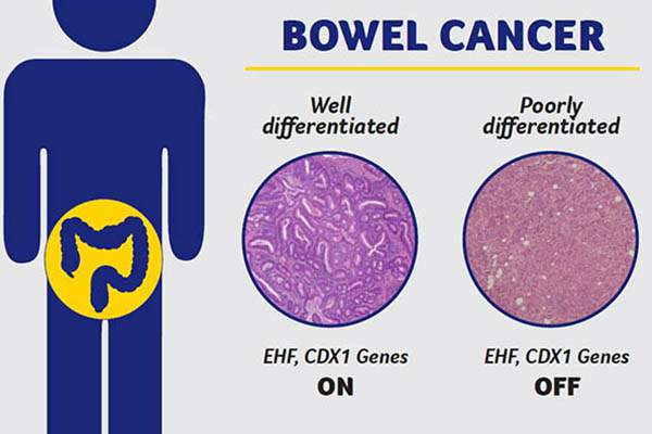 Stopping The Spread Of Bowel Cancer Cancer Council Victoria 8657