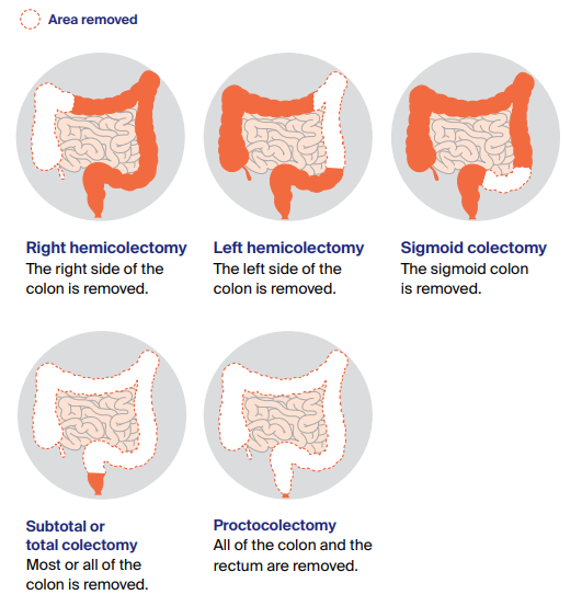 Colon Cancer Stages Symptoms