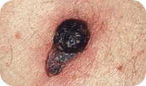 Skin Cancers (non-melanoma) - Cancer Council Victoria